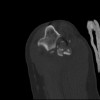 SPORK, NICO - 22.03.1976 - 02.08.2022 - CT obere Extremität - 17:58:51